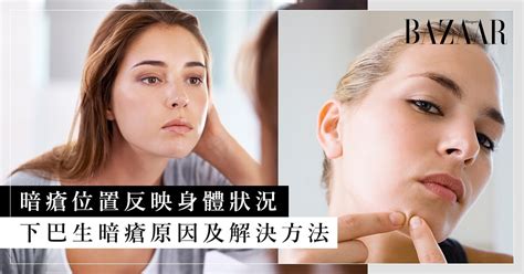 額頭 暗瘡|12個暗瘡位置揭示身體狀況｜中醫拆解人中、下巴、額 